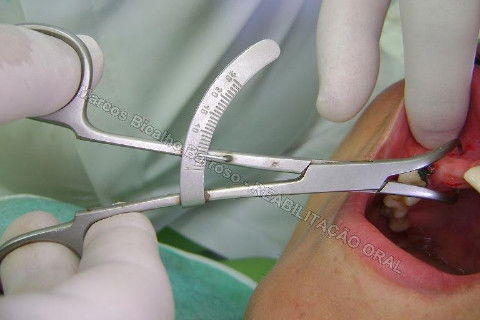 Avaliação da disponibilidade óssea com especímetro. Um recurso confiável, auxilia bastante na escolha dos implantes (seu diâmetro), pois determina a largura do rebordo ósseo. Neste caso, considerando o formato trapezoidal do rebordo (crista mais estreita que fundo de vestíbulo, normalmente), fazemos esta medida em 3 regiões: crista do rebordo, terço médio do rebordo e fundo de vestíbulo.