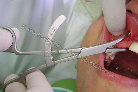 Reabilitação Oral - 10 Implantes Maxila e Mandíbula - Parte I - Planejamento