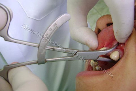 Reabilitação Oral - 10 Implantes Maxila e Mandíbula - Parte I - Planejamento