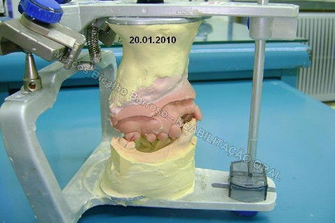 Reabilitação Oral - 10 Implantes Maxila e Mandíbula - Parte I - Planejamento