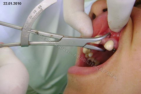 Reabilitação Oral - 10 Implantes Maxila e Mandíbula - Parte I - Planejamento