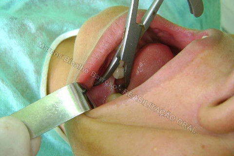 Reabilitação Oral - 10 Implantes Maxila e Mandíbula - Parte I - Planejamento