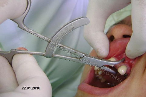 Reabilitação Oral - 10 Implantes Maxila e Mandíbula - Parte I - Planejamento