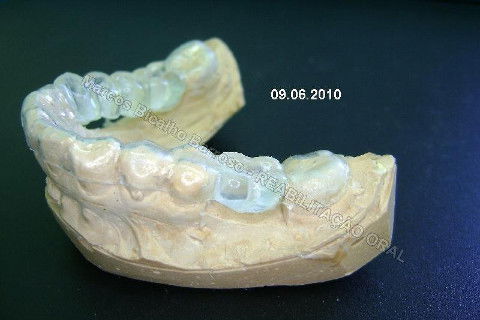 Reabilitação Oral - 10 Implantes Maxila e Mandíbula - Parte I - Planejamento