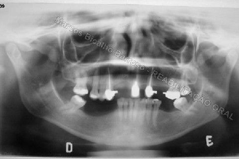 Reabilitação Oral - 10 Implantes Maxila e Mandíbula - Parte I - Planejamento
