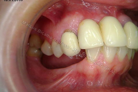 Reabilitação Oral - 10 Implantes Maxila e Mandíbula - Parte I - Planejamento