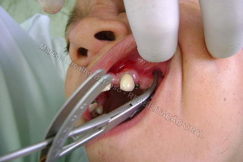 Reabilitação Oral - 10 Implantes Maxila e Mandíbula - Parte I - Planejamento