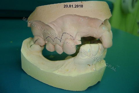 Reabilitação Oral - 10 Implantes Maxila e Mandíbula - Parte I - Planejamento