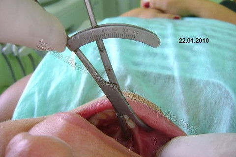 Reabilitação Oral - 10 Implantes Maxila e Mandíbula - Parte I - Planejamento