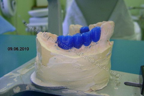 Reabilitação Oral - 10 Implantes Maxila e Mandíbula - Parte I - Planejamento