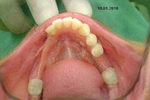 Reabilitação Oral - 10 Implantes Maxila e Mandíbula - Parte I - Planejamento