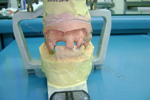 Reabilitação Oral - 10 Implantes Maxila e Mandíbula - Parte I - Planejamento