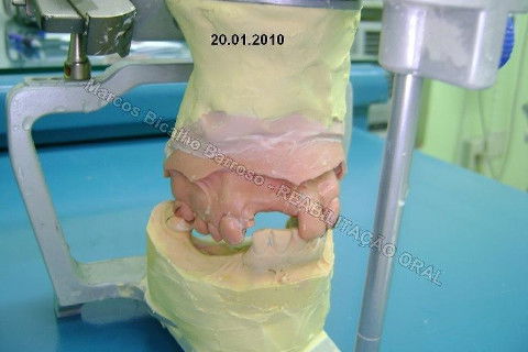 Reabilitação Oral - 10 Implantes Maxila e Mandíbula - Parte I - Planejamento