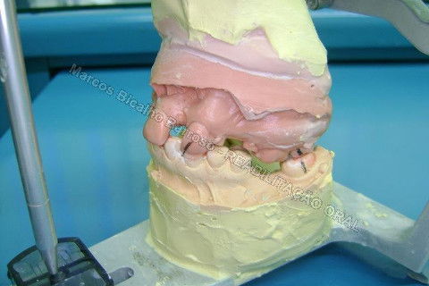 Reabilitação Oral - 10 Implantes Maxila e Mandíbula - Parte I - Planejamento