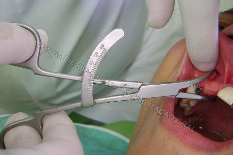 Reabilitação Oral - 10 Implantes Maxila e Mandíbula - Parte I - Planejamento