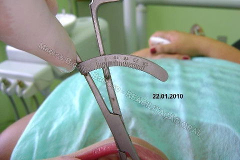 Reabilitação Oral - 10 Implantes Maxila e Mandíbula - Parte I - Planejamento