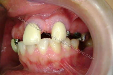 Reabilitação Oral - 10 Implantes Maxila e Mandíbula - Parte I - Planejamento