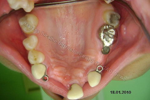 Reabilitação Oral - 10 Implantes Maxila e Mandíbula - Parte I - Planejamento