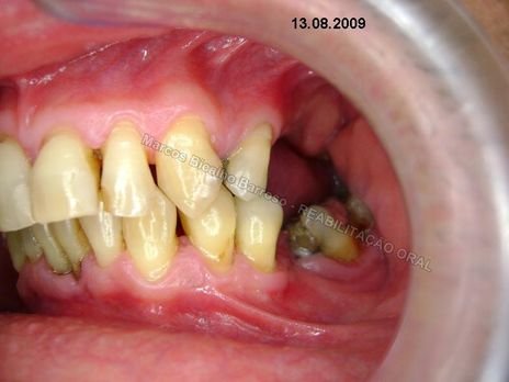 Cirugia Periodontal a Retalho com as Principais Finalidades : Profilaxia para Cirurgia Cardíaca e Implantodôntica