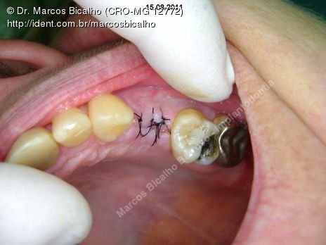 Implantes 14, 24 - Levantamento de Seio Traumático (14) e Atraumático (24) com Implantes na Mesma Sessão do Enxerto - Parte Ii