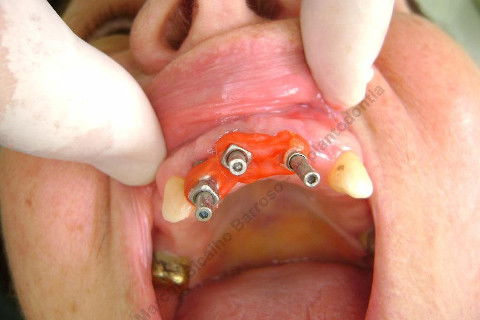 3 Implantes Imediatos na Maxila + Remoção de Cisto Apical - Parte Ii - Fase Protética