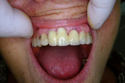 3 Implantes Imediatos na Maxila + Remoção de Cisto Apical - Parte Ii - Fase Protética