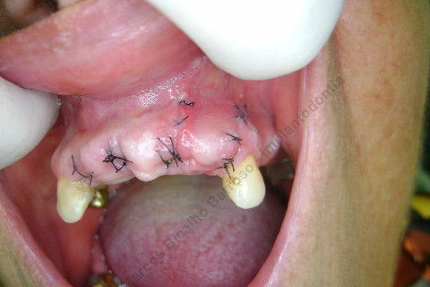 3 Implantes Imediatos na Maxila + Remoção de Cisto Apical - Parte Ii - Fase Protética