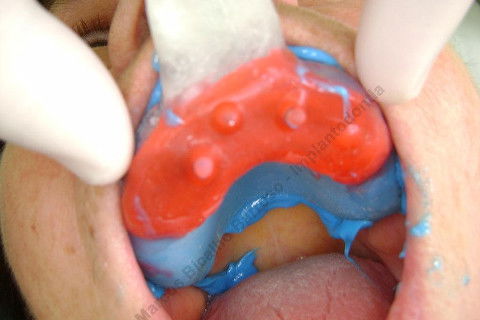 3 Implantes Imediatos na Maxila + Remoção de Cisto Apical - Parte Ii - Fase Protética