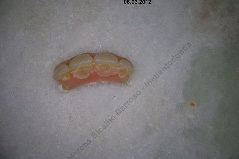 3 Implantes Imediatos na Maxila + Remoção de Cisto Apical - Parte Ii - Fase Protética