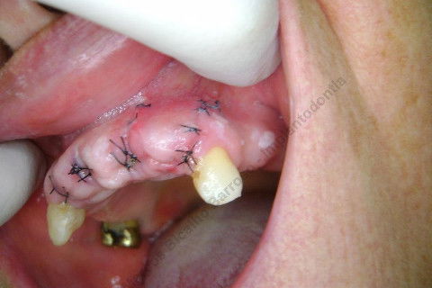 3 Implantes Imediatos na Maxila + Remoção de Cisto Apical - Parte Ii - Fase Protética