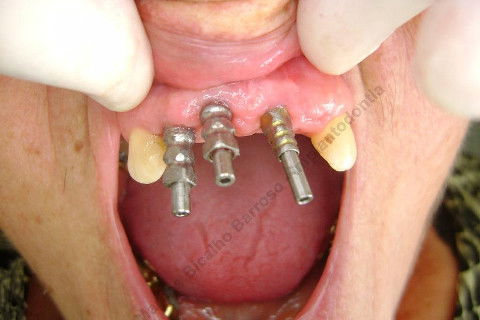 Transferentes de moldeira aberta...