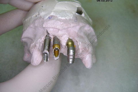 3 Implantes Imediatos na Maxila + Remoção de Cisto Apical - Parte Ii - Fase Protética