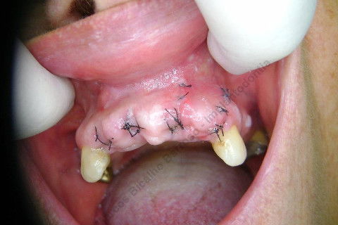Remoção da sutura...