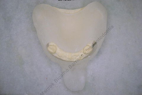 3 Implantes Imediatos na Maxila + Remoção de Cisto Apical - Parte Ii - Fase Protética