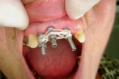 3 Implantes Imediatos na Maxila + Remoção de Cisto Apical - Parte Ii - Fase Protética
