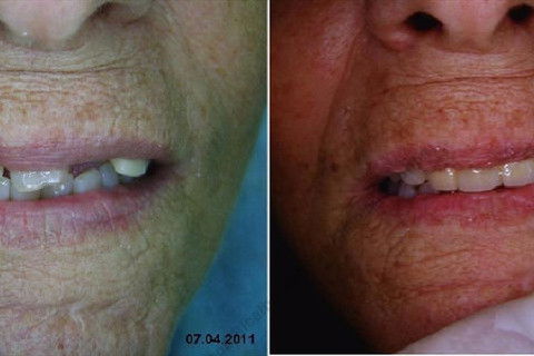 3 Implantes Imediatos na Maxila + Remoção de Cisto Apical - Parte Ii - Fase Protética