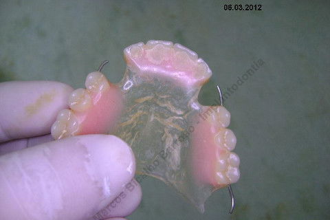 3 Implantes Imediatos na Maxila + Remoção de Cisto Apical - Parte Ii - Fase Protética