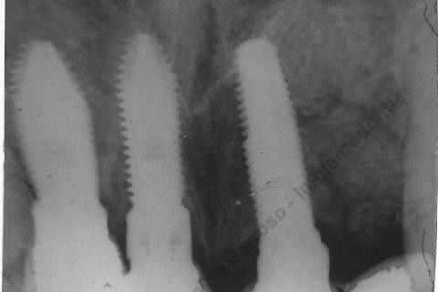 3 Implantes Imediatos na Maxila + Remoção de Cisto Apical - Parte Ii - Fase Protética