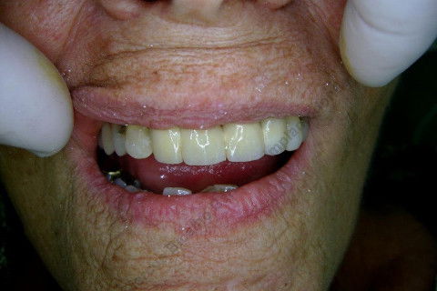 3 Implantes Imediatos na Maxila + Remoção de Cisto Apical - Parte Ii - Fase Protética