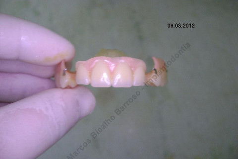 3 Implantes Imediatos na Maxila + Remoção de Cisto Apical - Parte Ii - Fase Protética