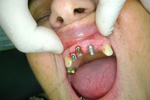 3 Implantes Imediatos na Maxila + Remoção de Cisto Apical - Parte Ii - Fase Protética