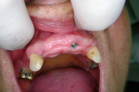 Instalação dos cicatrizadores...