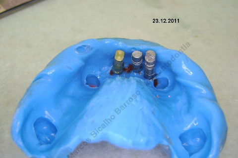 3 Implantes Imediatos na Maxila + Remoção de Cisto Apical - Parte Ii - Fase Protética