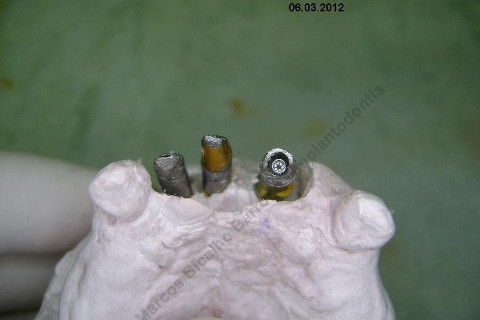 3 Implantes Imediatos na Maxila + Remoção de Cisto Apical - Parte Ii - Fase Protética