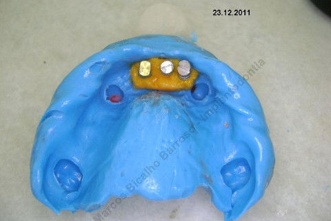 3 Implantes Imediatos na Maxila + Remoção de Cisto Apical - Parte Ii - Fase Protética