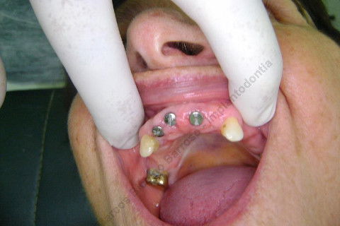 3 Implantes Imediatos na Maxila + Remoção de Cisto Apical - Parte Ii - Fase Protética