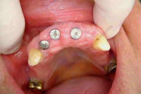 3 Implantes Imediatos na Maxila + Remoção de Cisto Apical - Parte Ii - Fase Protética