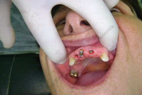 3 Implantes Imediatos na Maxila + Remoção de Cisto Apical - Parte Ii - Fase Protética