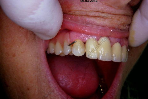 3 Implantes Imediatos na Maxila + Remoção de Cisto Apical - Parte Ii - Fase Protética