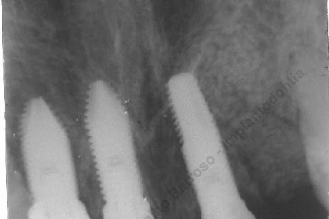 3 Implantes Imediatos na Maxila + Remoção de Cisto Apical - Parte Ii - Fase Protética
